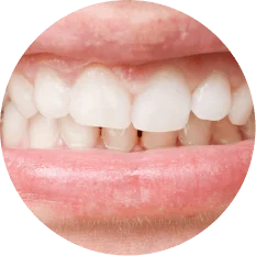 Misaligned Tooth / Teeth