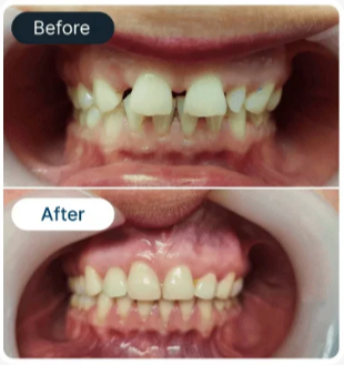 Smile Result